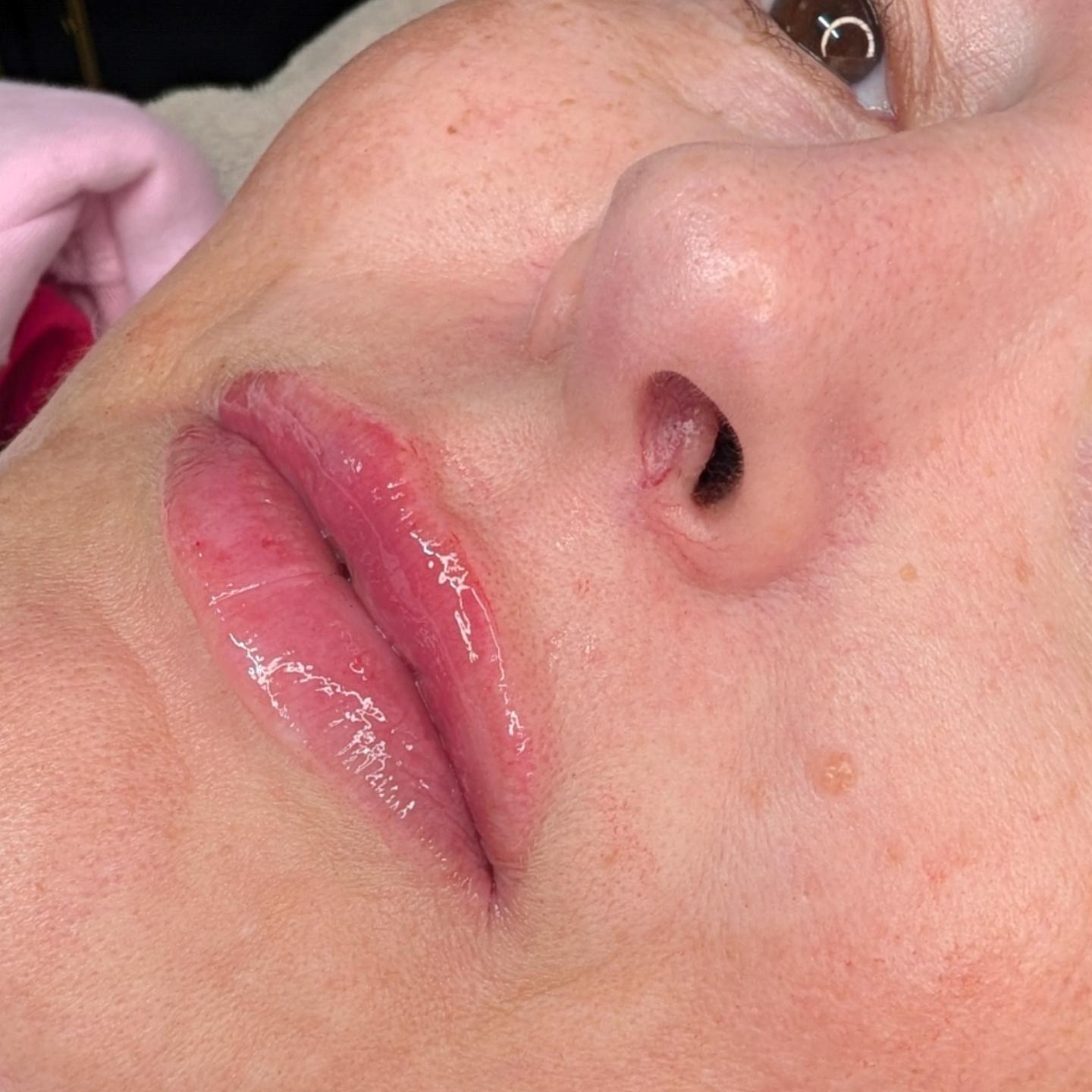 Natural looking lip filler, close up